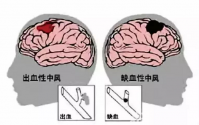 脑梗、心梗、脑中风等心脑血管人群都应该吃小分子肽