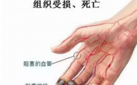 小分子肽对静脉曲张和脉管炎效果怎么样？能不能根治？