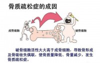 中老年人不得不预防骨质疏松症！骨胶原蛋白肽真能改善骨质疏松吗？