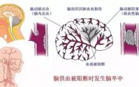脑中风怎么治疗好？干细胞与治疗脑中风的作用是什么？