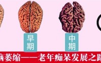 哪些因素导致脑萎缩？干细胞与治疗脑萎缩的作用特点！