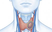 槐米槲皮素对甲状腺结节辅助干预研究