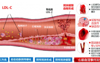 吃什么药物能快速消除动脉斑块