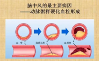 小分子肽能治疗脑中风后遗症吗？喝什么小分子肽效果好？