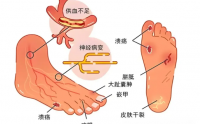 糖尿病足吃什么才能愈合？糖尿病足怎么办哪里治疗的效果好