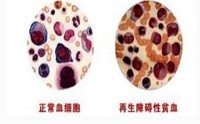 再生障碍性贫血有哪些症状？再生障碍性贫血吃骨髓肽效果怎么样？