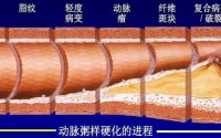 干细胞疗法缓解动脉粥样硬化降低心脑血管疾病的风险，干细胞与动脉粥样硬化的作用！