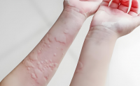 菊苣在治疗瘙痒症中的应用