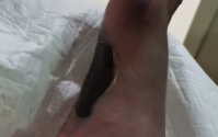 清蛋白肽和大豆小分子肽在改善血液循环系统的实例