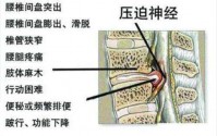 腰椎间盘突出的危害有哪些？补骨髓与腰椎间盘突的重要作用！