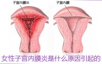 子宫内膜炎影响生育吗？干细胞疗法与子宫内膜损伤修复作用！