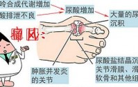 如何缓解痛风疼痛降低尿酸指数？了解干细胞与冶疗痛风的作用！