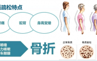 中老年人骨质疏松怎样调理,人参牛骨髓肽预防骨质疏松的应用效果。