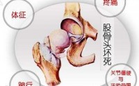 股骨头坏死怎么治疗好？干细胞与治疗股骨头坏死的作用原理！
