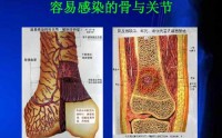 骨髓炎严重吗？骨髓炎的临床症状，骨髓炎如何防治？
