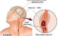 脑中风怎么办？小分子肽对脑中风后遗症有什么作用？