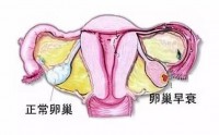 卵巢早衰怎么造成的,卵巢早衰的症状有哪些?