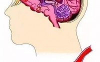 脑卒中怎么治疗好？干细胞与治疗脑卒中的临床应用研究！