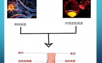 糖尿病足形成的原因,生物活性多糖与促进糖尿病足伤口愈合。