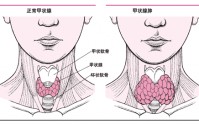 甲状腺结节有什么症状？甲状腺结节患者如何自我调理？
