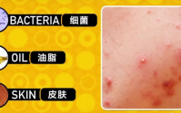  菊苣金银花治疗青春豆效果好吗？