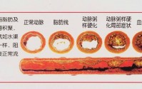 干细胞疗法：间充质干细胞与改善动脉粥样硬化干预消退动脉斑块的作用
