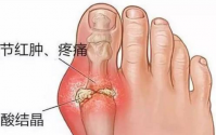 益生菌改善肠道竟然能降尿酸改善痛风