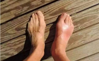 过度节食可以导致痛风发作是不是骗人的？有什么科学依据
