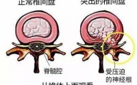 腰间盘突出吃牛骨髓肽可以吗？牛骨髓肽真能调理腰椎病吗？