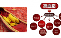 高血脂对心梗的影响,纳豆地龙蛋白肽在调节高血脂方面的应用.