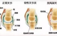 关节炎关节疼痛是怎么形成的？小分子肽修复关节的作用！