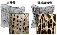 骨质疏松补钙可以吗？改善骨质疏松增加骨密度还需要骨胶原肽来促进钙吸收！