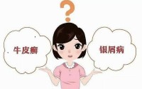 牛皮癣如何治疗效果好？吃什么药能彻底根治牛皮癣？