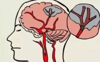 脑卒中是怎么引起的？如何预防脑卒中预防的发生？