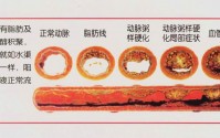 动脉粥样硬化是怎么形成的?地龙蛋白能预防动脉硬化吗？