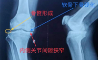 骨髓间充质干细胞与关节修复，干细胞与关节炎