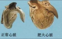 心脏肥大吃小分子活性肽可以吗？活性肽对心脏肥大的改善有什么效果？