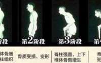 医案：治好胃病强直性脊柱炎却好了！