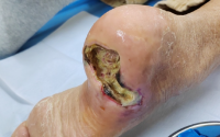 糖尿病足签约干预方案