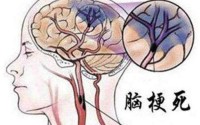 干细胞疗法能治疗脑梗吗？干细胞与缺血性脑血管病的作用原理！