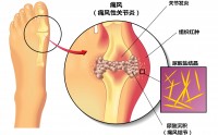 痛风的原因有哪些,痛风常常发作怎么办?