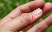 小分子肽对痛风的作用效果怎么样，能根治痛风吗？