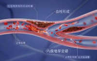 豆激酶是天然的溶栓剂