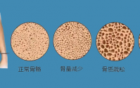 牛骨髓肽对骨质疏松的作用效果