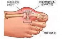 肽对痛风有什么作用？怎么减少痛风疼痛？