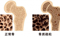 干细胞疗法在治疗骨质疏松中的应用情况