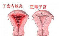 引发子宫内膜炎的因素有哪些？如何预防子宫内膜炎？肽对妇科炎症的调理作用！
