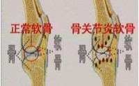 干细胞预防改善骨关节疾病，干细胞外泌体治疗骨关节炎的作用原理！