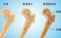 牛骨髓肽对更年期女性骨骼健康的辅助营养干预,牛骨髓肽能预防骨质疏松吗？