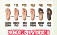 糖尿病足怎么预防,活性多糖能帮助糖尿病足愈合吗?